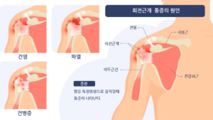 회전근개 증후군 원인